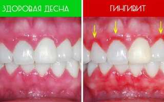 Лечение гингивита народными средствами