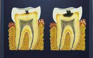 После удаления зуба опухла щека что делать у ребенка