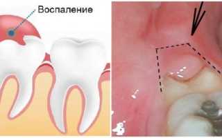 Как проходит удаление капюшона зуба мудрости