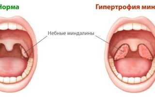 Язвочки на гландах без температуры у взрослого