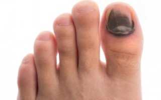 Почему посинел ноготь на ноге, когда обратиться к врачу? Причины, лечение и профилактика