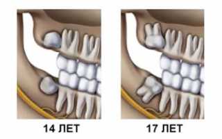 Когда растут и прорезываются зубы мудрости