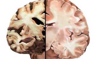 Мультисистемная атрофия: причины, признаки, диагностика, лечение