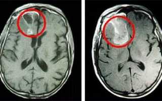 5 возможных причин возникновения глиомы головного мозга