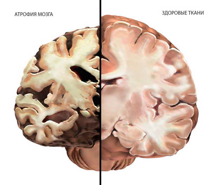 Мультисистемная атрофия