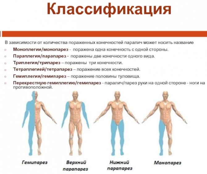 Спастический тетрапарез у детей. Что это такое, причины и лечение