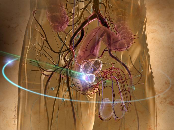 Рак уретры у мужчин и женщин - Онкоурология