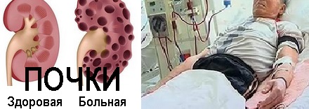 хроническая почечная недостаточность симптомы лечение