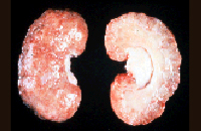 Урологические болезни почечная недостаточность