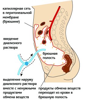 Механизм перитонеального диализа Механизм перитонеального диализа